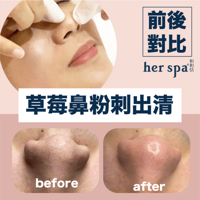 黑頭粉刺去除乾淨 去黑頭粉刺 洗臉去粉刺 鼻頭粉刺去除 草莓鼻粉刺去除