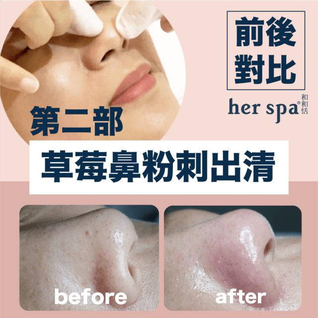 黑頭粉刺去除乾淨 去黑頭粉刺 洗臉去粉刺 鼻頭粉刺去除 草莓鼻粉刺去除